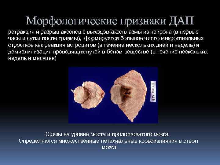 Морфологические признаки ДАП ретракция и разрыв аксонов с выходом аксоплазмы из нейрона (в первые