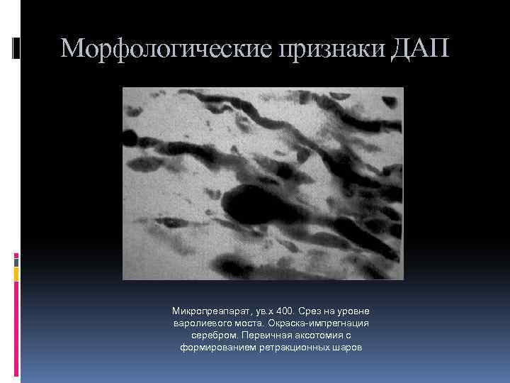 Морфологические признаки ДАП Микропреапарат, ув. х 400. Срез на уровне варолиевого моста. Окраска-импрегнация серебром.