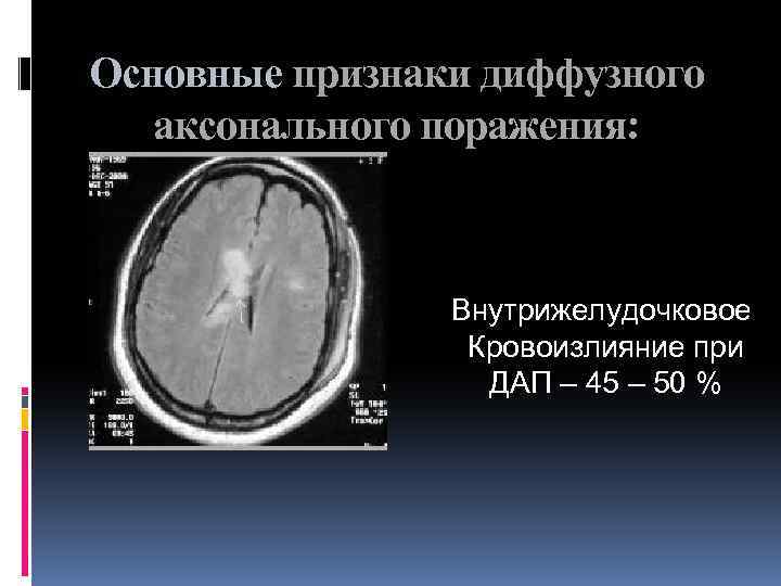 Основные признаки диффузного аксонального поражения: Внутрижелудочковое Кровоизлияние при ДАП – 45 – 50 %