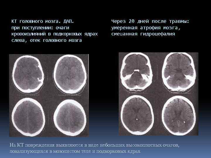 КТ головного мозга. ДАП. при поступлении: очаги кровоизлияний в подкорковых ядрах слева, отек головного