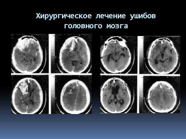 Хирургическое лечение ушибов головного мозга 