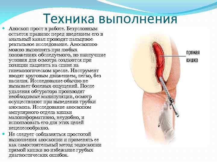 Техника выполнения Аноскоп прост в работе. Безусловным остается правило: перед введением его в анальный