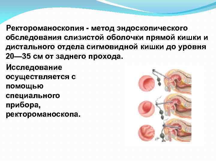 Ректороманоскопия - метод эндоскопического обследования слизистой оболочки прямой кишки и дистального отдела сигмовидной кишки