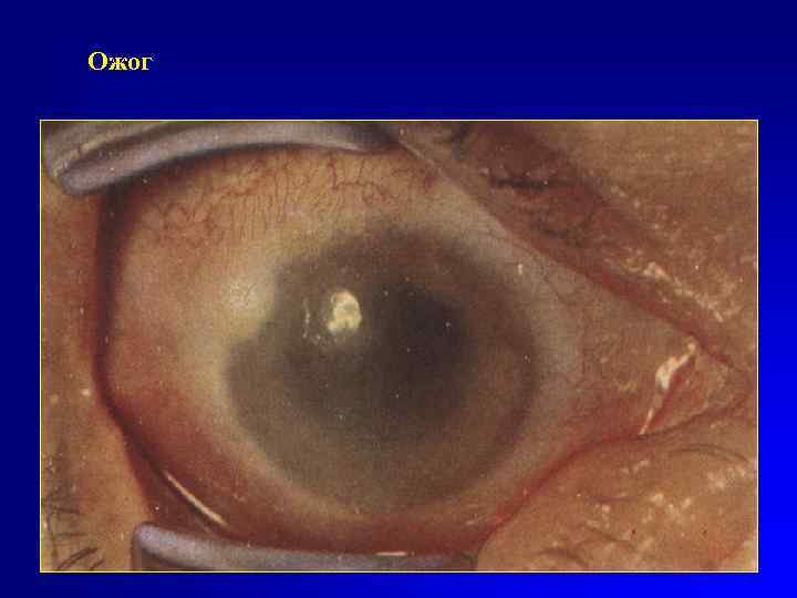 Ожог 