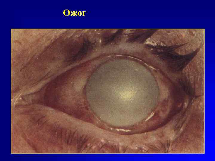 Ожог 