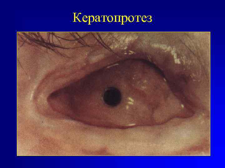 Кератопротез 