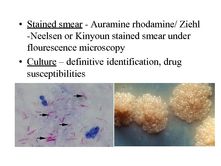  • Stained smear - Auramine rhodamine/ Ziehl -Neelsen or Kinyoun stained smear under