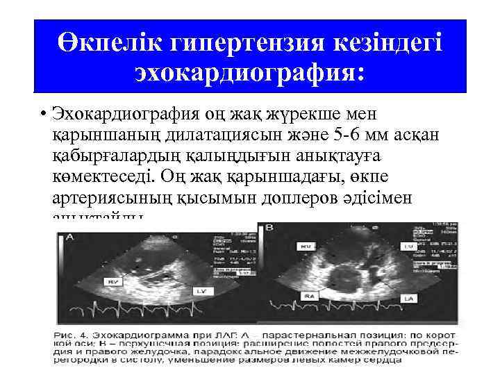 Өкпелік гипертензия кезіндегі эхокардиография: • Эхокардиография оң жақ жүрекше мен қарыншаның дилатациясын және 5