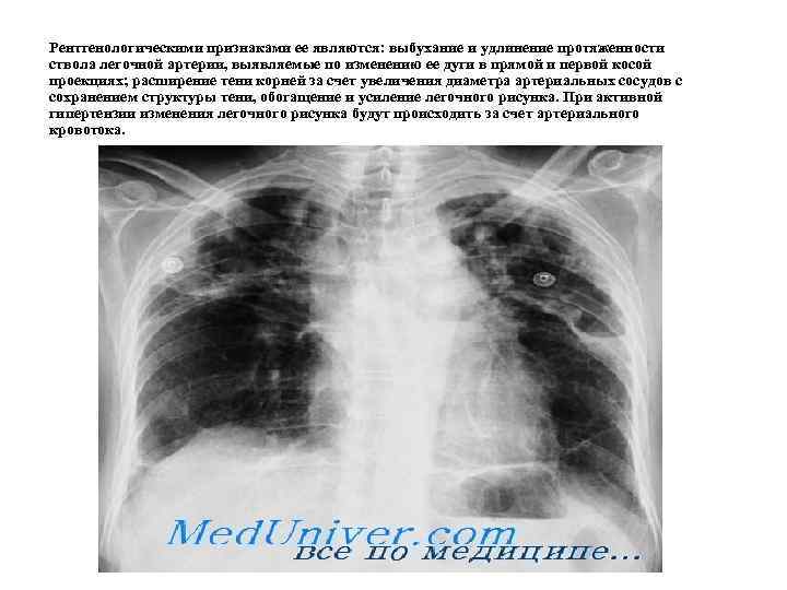 Рентгенологическими признаками ее являются: выбухание и удлинение протяженности ствола легочной артерии, выявляемые по изменению