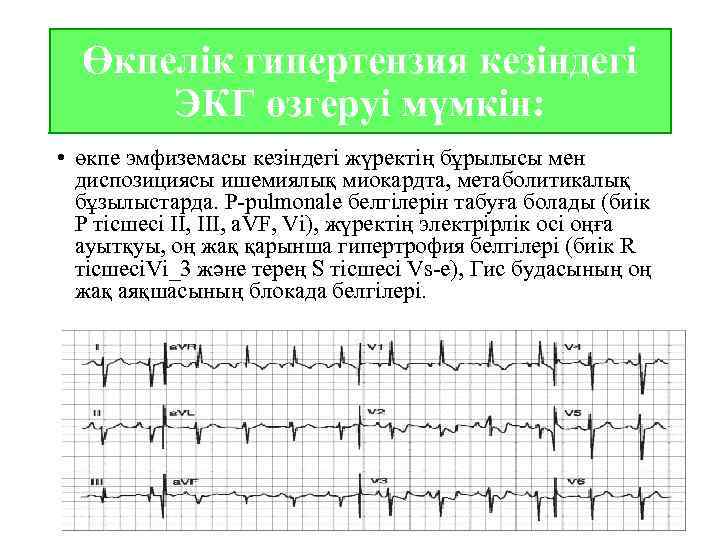 Өкпелік гипертензия кезіндегі ЭКГ өзгеруі мүмкін: • өкпе эмфиземасы кезіндегі жүректің бұрылысы мен диспозициясы