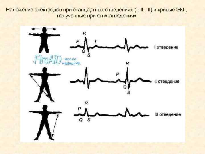 Наложение электродов при стандартных отведениях (I, III) и кривые ЭКГ, полученные при этих отведениях