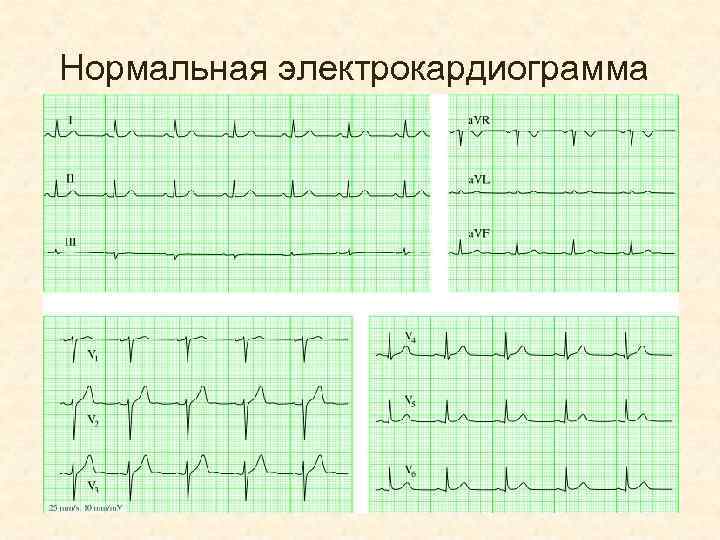 Нормальная электрокардиограмма 