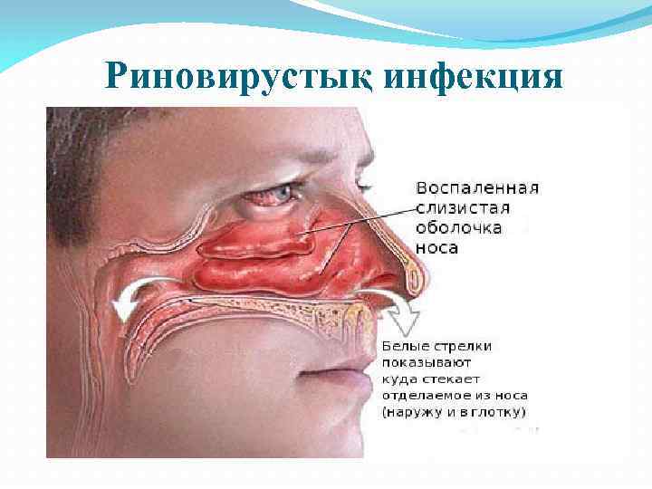 Риновирустық инфекция 