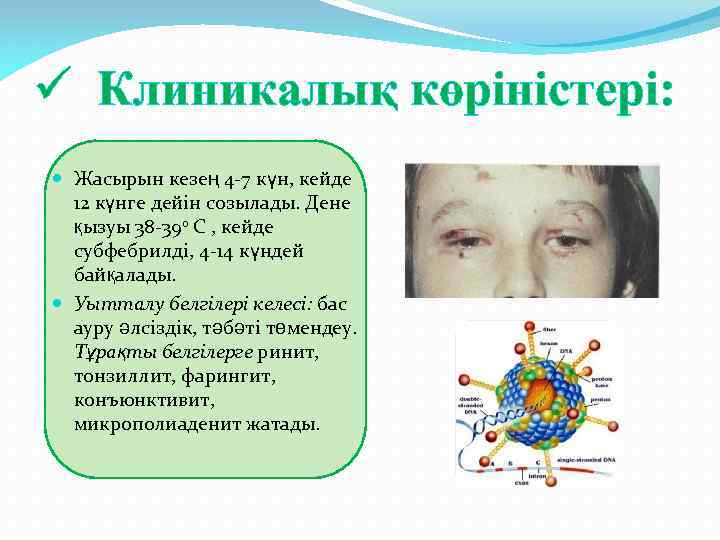 ü Клиникалық көріністері: Жасырын кезең 4 -7 күн, кейде 12 күнге дейін созылады. Дене