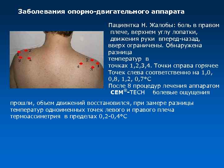 Заболевания опорно-двигательного аппарата Пациентка Н. Жалобы: боль в правом плече, верхнем углу лопатки, движения
