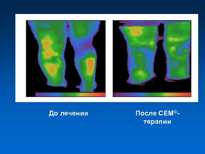 До лечения После СЕМ®терапии 