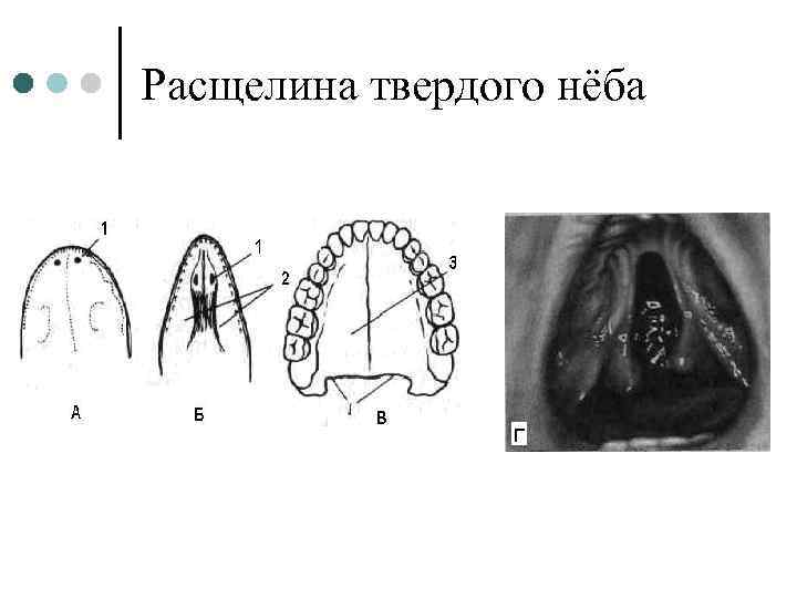 Расщелина твердого нёба 