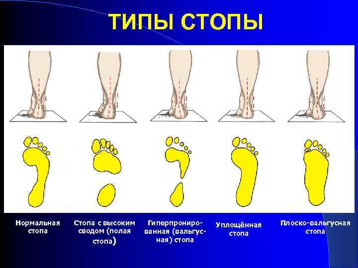 Подошвенный фасциит стопы фото