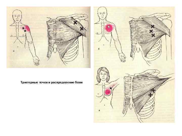Триггерные точки и распределение боли 