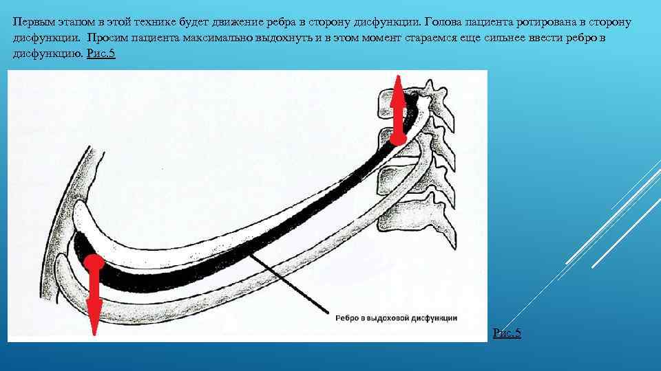 Первым этапом в этой технике будет движение ребра в сторону дисфункции. Голова пациента ротирована