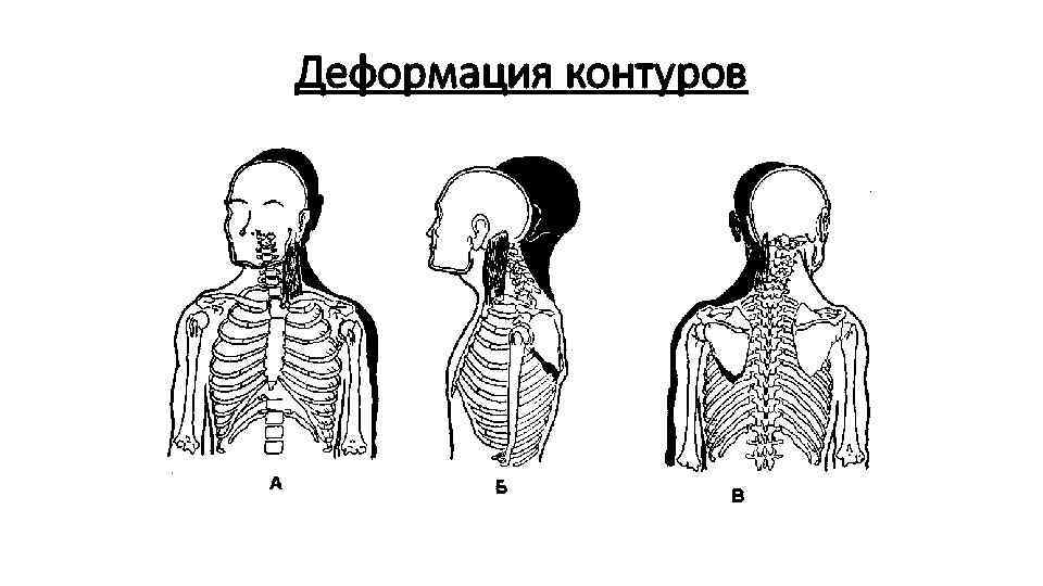 Деформация контуров 