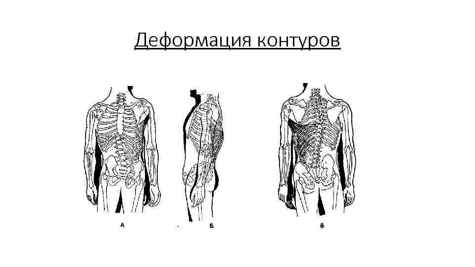 Деформация контуров 