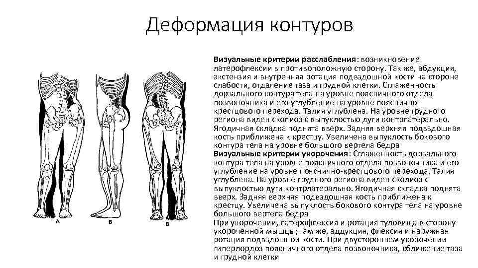 Деформация контуров Визуальные критерии расслабления: возникновение латерофлексии в противоположную сторону. Так же, абдукция, экстензия