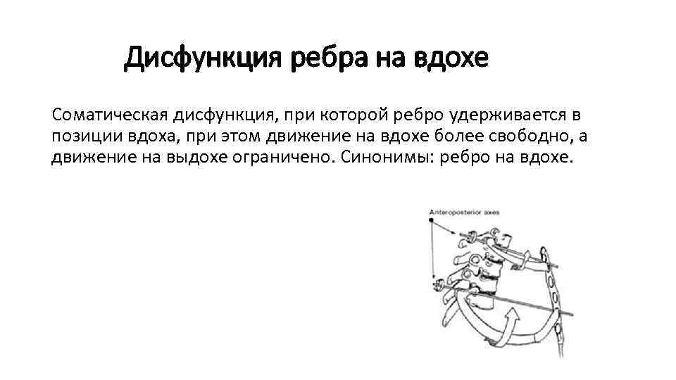 Дисфункция ребра на вдохе Соматическая дисфункция, при которой ребро удерживается в позиции вдоха, при