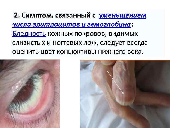 2. Симптом, связанный с уменьшением числа эритроцитов и гемоглобина: Бледность кожных покровов, видимых слизистых