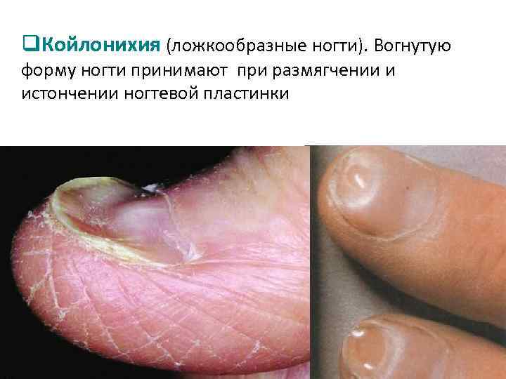q. Койлонихия (ложкообразные ногти). Вогнутую форму ногти принимают при размягчении и истончении ногтевой пластинки