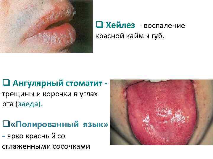 q Хейлез - воспаление красной каймы губ. q Ангулярный стоматит трещины и корочки в