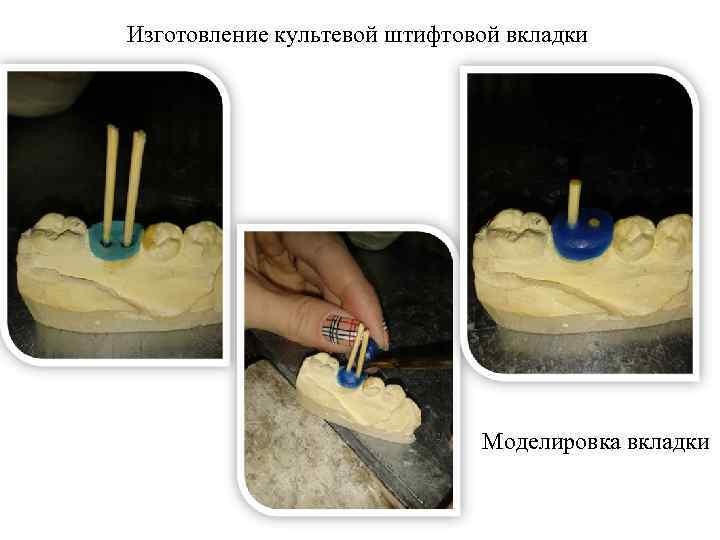 Изготовление культевой штифтовой вкладки Моделировка вкладки 