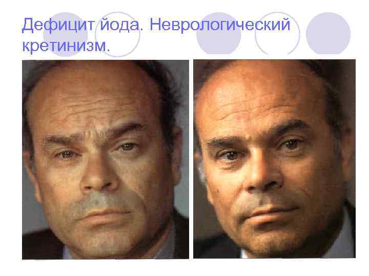 Дефицит йода. Неврологический кретинизм. 