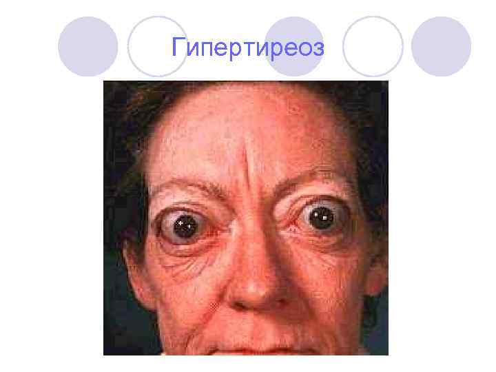 Гипертиреоз 