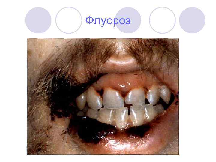 Флуороз 