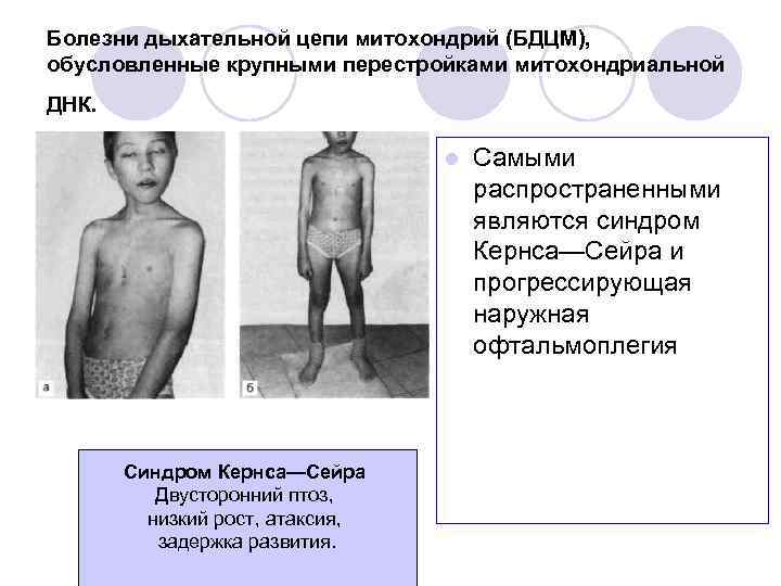 Болезни дыхательной цепи митохондрий (БДЦМ), обусловленные крупными перестройками митохондриальной ДНК. l Синдром Кернса—Сейра Двусторонний