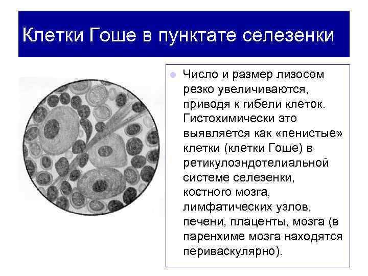 Клетки накопления. Селезенка при болезни Гоше микропрепарат. Болезнь Гоше патанатомия. Селезенка при болезни Гоше патанатомия.