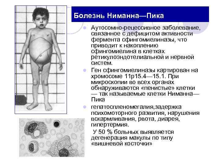 Болезнь Ниманна—Пика Аутосомно рецессивное заболевание, связанное с дефицитом активности фермента сфингомиелиназы, что приводит к