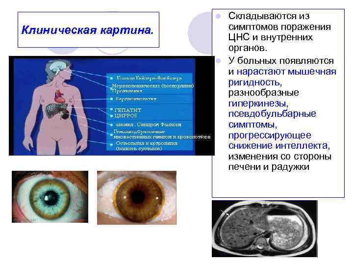 Клиническая картина гепатита в