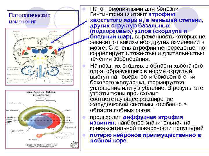 Патогномоничными для болезни Гентингтона считают атрофию хвостатого ядра и, в меньшей степени, других структур