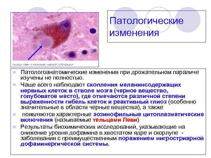 Патологические изменения Патологоанатомические изменения при дрожательном параличе изучены не полностью. l Чаще всего наблюдают
