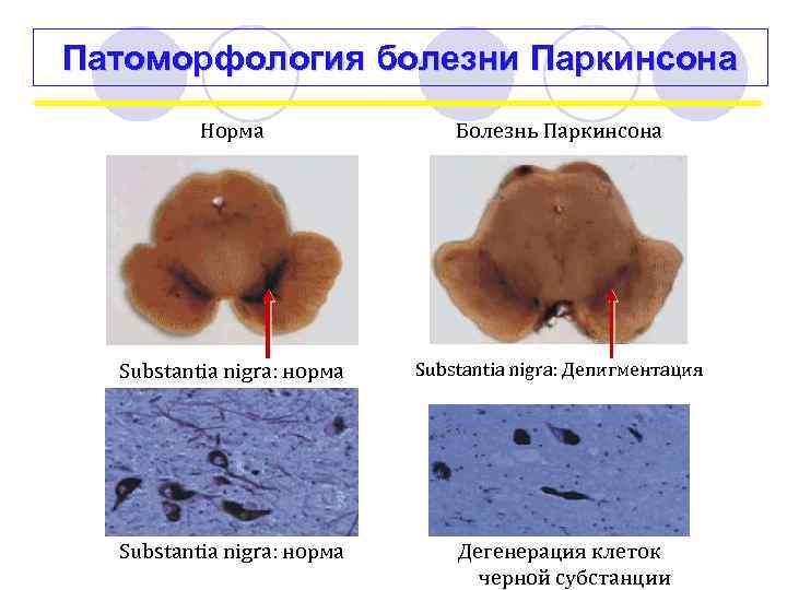 Патоморфология болезни Паркинсона Норма Болезнь Паркинсона Substantia nigra: норма Substantia nigra: Депигментация Substantia nigra: