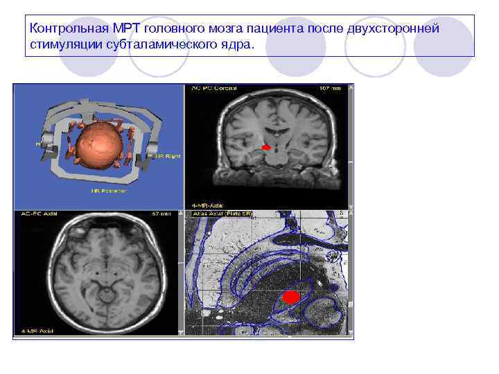 Контрольная МРТ головного мозга пациента после двухсторонней стимуляции субталамического ядра. 