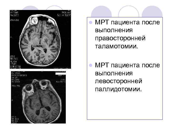 l МРТ пациента после выполнения правосторонней таламотомии. l МРТ пациента после выполнения левосторонней паллидотомии.