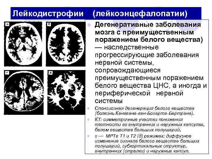 Дегенеративные заболевания мозга. Мультифокальная лейкоэнцефалопатия мрт. Прогрессирующая мультифокальная лейкоэнцефалопатия кт. Прогрессирующая сосудистая лейкоэнцефалопатия.