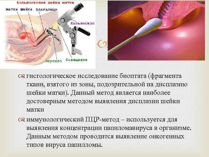  гистологическое исследование биоптата (фрагмента ткани, взятого из зоны, подозрительной на дисплазию шейки матки).