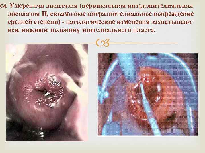  Умеренная дисплазия (цервикальная интраэпителиальная дисплазия II, сквамозное интраэпителиальное повреждение средней степени) - патологические