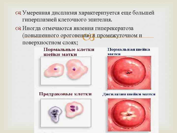  Умеренная дисплазия характеризуется еще большей гиперплазией клеточного эпителия. Иногда отмечаются явления гиперекератоза (повышенного