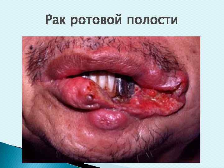 Рак ротовой полости 