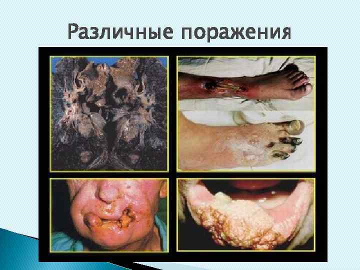 Различные поражения 